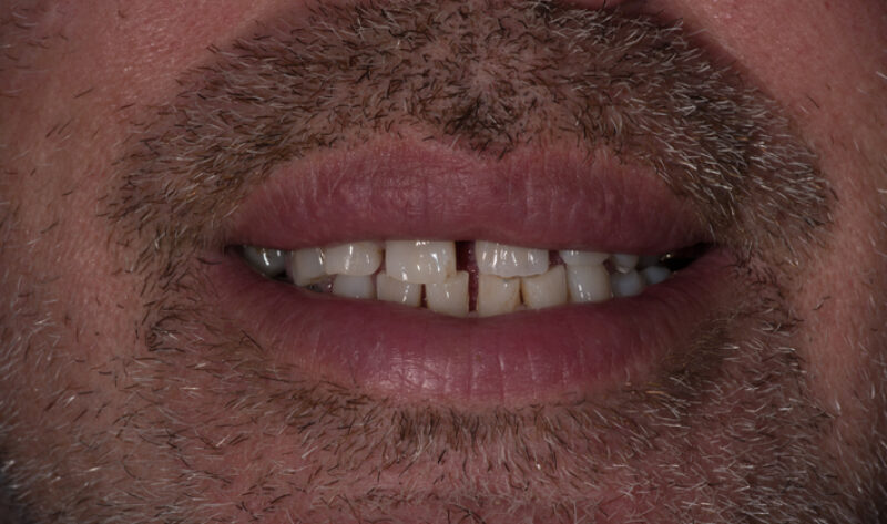 After - Rowtree Dental Care